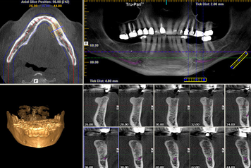 ct scan